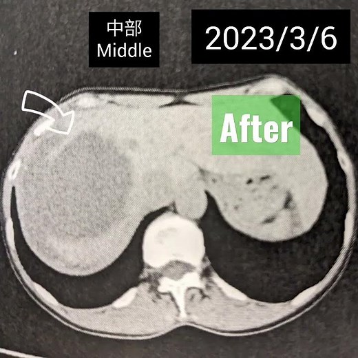 巨大肝嚢胞CT‪@reiko-ohnishi‬ #beforeafter #エタノール #術後 #退院