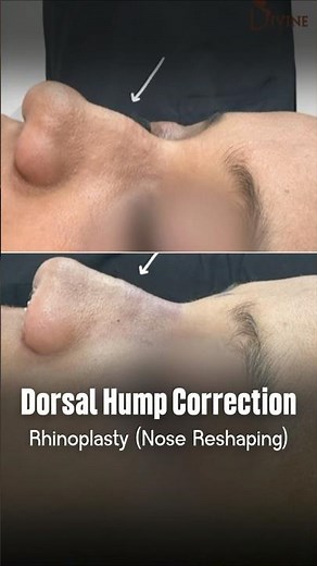 Dorsal Hump Rhinoplasty | Nose Reshaping Surgery Before & After