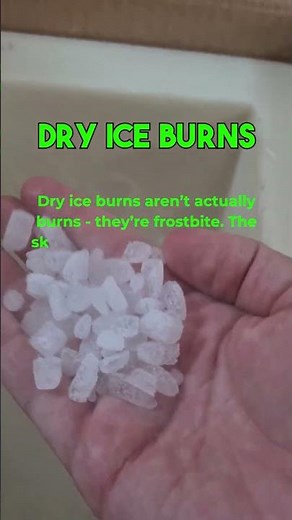 🥶 Dry Ice Burns: Why They’re Actually Frostbite!