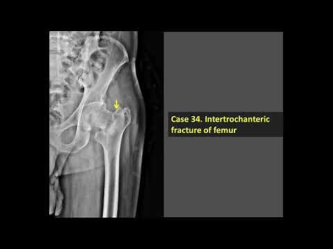 Intertrochanteric Fracture of Femur (X-Ray)