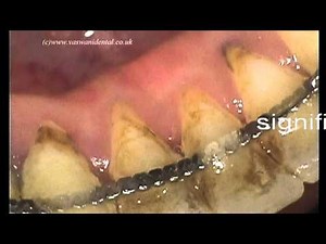 Non Surgical Periodontal Treatment