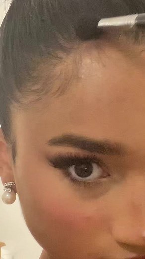 Gymnast Hairline Troubles: Dealing with Receding Hairlines from Gymnastics Buns