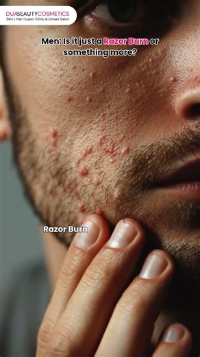 Men Is it just a Razor Burn or something more? Learn more in the description 👇 #skincareclinic