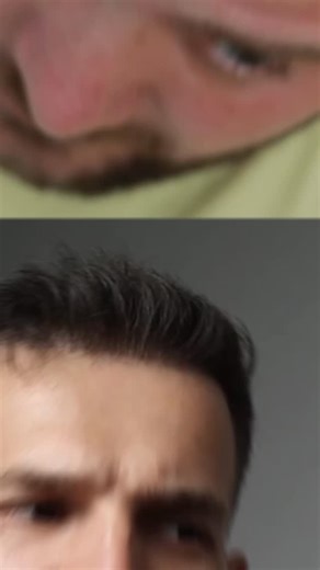 𝐈 𝐃 𝐑 𝐈 𝐒 𝐑 𝐄 𝐙 𝐀 𝐈 on Instagram: "Update on cure for baldness 2027 😳"