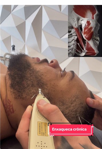 Entenda a Enxaqueca Crônica e Seus Sintomas