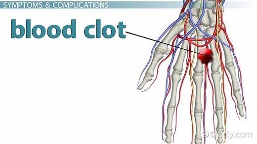 Blood Clot in the Hand: Symptoms, Signs & Treatment