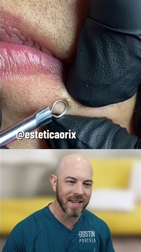 Dermatologist Explains: Why Nose Filaments Always Come Back (And When to Stop Pushing)