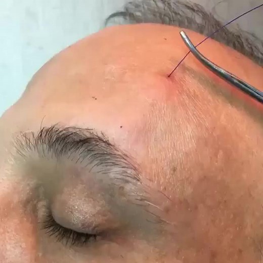 Pdo thread lift eyebrow lift #pdothreads #eyebrowlift #threadlift #tiktok #plasticsurgery #pdothreadlift