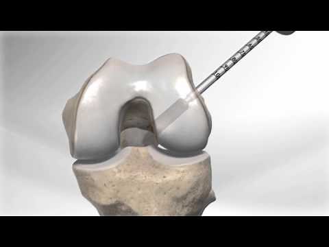 All Inside® ACL Reconstruction with GraftLink™