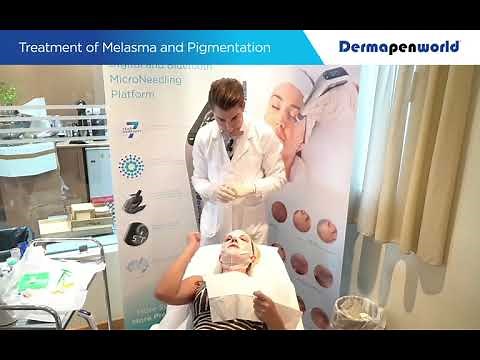 Dermapen 4 Treatment Melasma