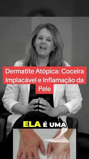 Dermatite Atópica: Coceira Implacável e Inflamação da Pele