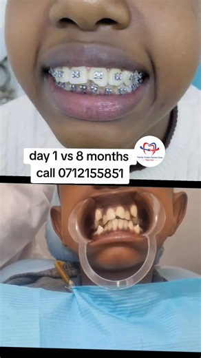 Braces deliver unmatched results by creating healthier, straighter, and more confident smiles. Start your smile transformation with us today, and we’ll celebrate your journey by sharing your amazing before-and-after results. Book your consultation and take the first step toward your dream smile!#bracesinnairobi #bracesnairobi #bracesjourney #foryou #kenyattauniversity @family crown Dental Mombasa @family crown dental eldoret