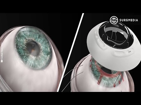 Synthetic Cornea Implanted in First Patient