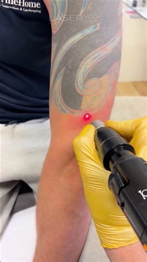 PicoSure Pro Tattoo Removal in Action | Black & Blue Ink Laser Treatment