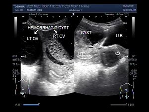 Bilateral large Hemorrhagic ovarian cysts.