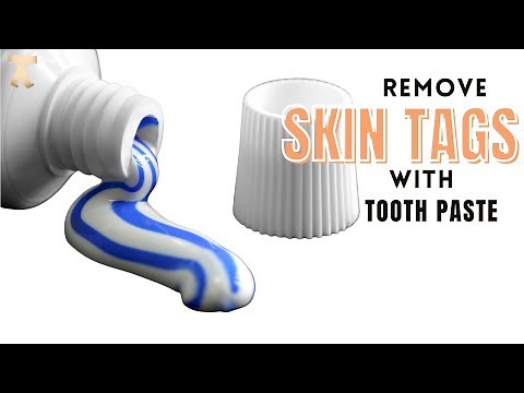 In 1 Night |How To Quickly Remove Skin Tags | Remove Skin Tags Naturally | Get Rid Of Skin Tags