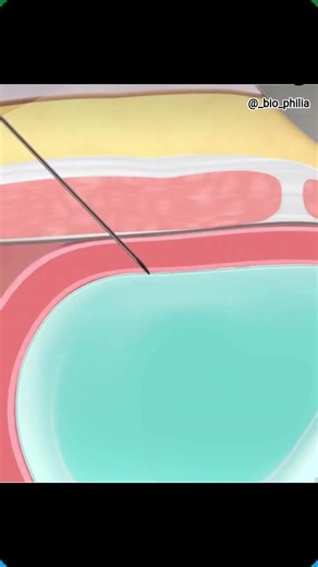 What Is the Amniotic Sac? Baby’s Water Bag Explained Simply #amnioticfluid #amniocentesis #medical