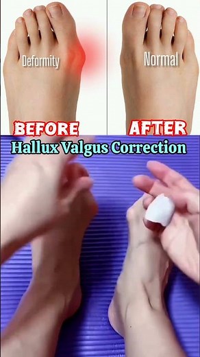 Hallux Valgus correction splint! do this ! #exercise #orthotics #trend #shortsfeed #shorts #viral