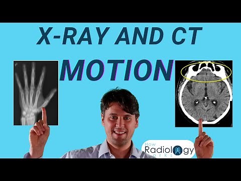 CT motion artifacts (Motion Blur in X-ray)