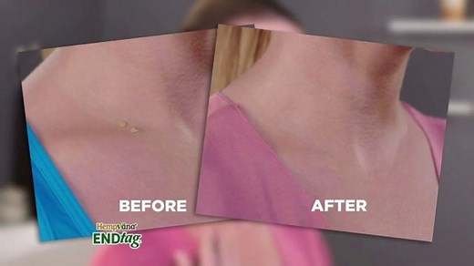 Hempvana End Tag TV Spot, 'Put an End to Skin Tags'