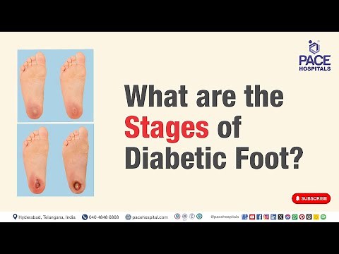 Diabetic Foot Stages | What are the Stages of Diabetic Foot? | #diabeticfootstages
