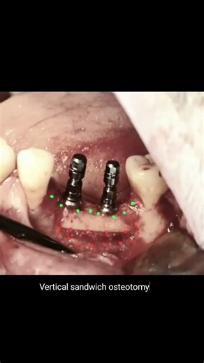 Vertikal sandwich osteotomi ile dikey kemik kazanımı@dr dt zuhalmetesirin #implant #dentalimplan