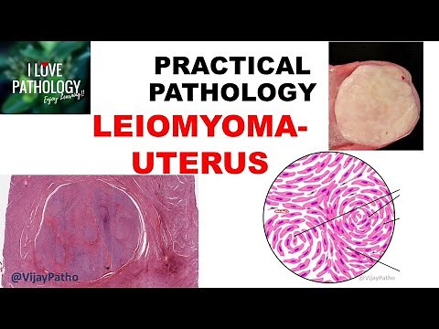 LEIOMYOMA UTERUS: etiology, Clinical features, Gross & Microscopy