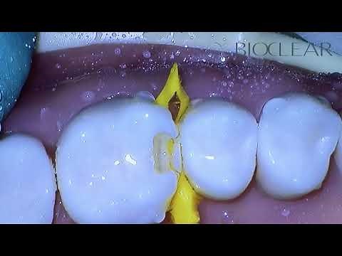 Bioclear Matrix | The Bioclear Class II Prep using Komet Burs