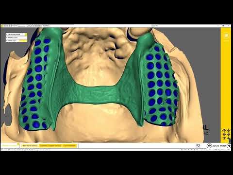 Tutorial - Exocad Modellguss mit Teleskopen als Einstück A-Z