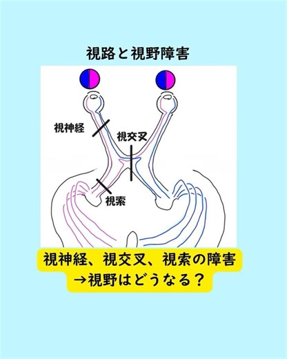#視路 #視神経 #視交叉 #視索 #RAPD #同名半盲 の鑑別