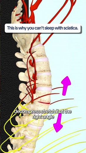 MRI-guided spinal decompression relieves sciatica pain without surgery #spine #health