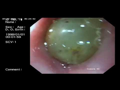 Foreign Body removal Endoscopy