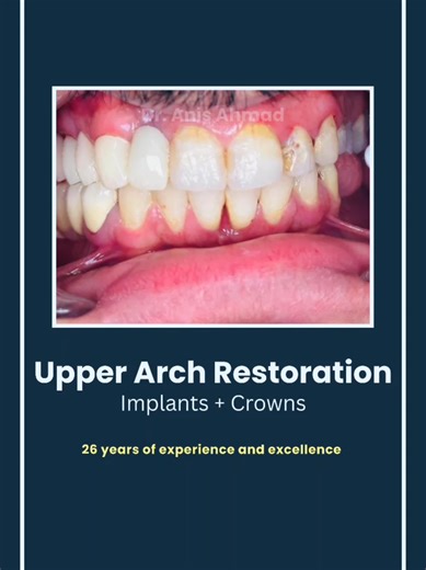 This case focuses exclusively on the maxillary (upper) arch, with no treatment performed on the lower teeth. The treatment plan included the placement of 3 dental implants, preparation of 3 natural teeth for crowns, and the cementation of 6 high-strength zirconia crowns, 3 implant-supported and 3 tooth-supported. The goal was to restore function, aesthetics, and long-term stability while maintaining harmony with the existing lower arch. A precise, minimally invasive approach ensured predictable 