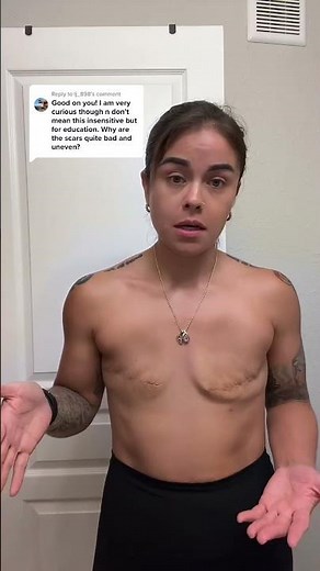 Aesthetic flat closure scars after a double mastectomy