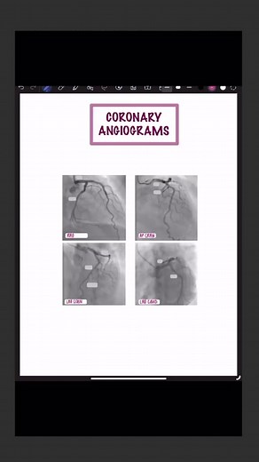 Coronary Angiogram Views & Anatomy Identification . My top requested ... | anatomy
