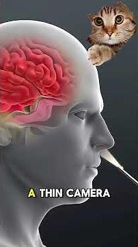 Endoscopic Transsphenoidal Surgery 2025 | 3D Animation of Pituitary Tumor Removal & Surgical Steps