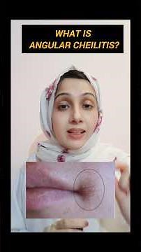 What is angular cheilitis?Who gets angular cheilitis?