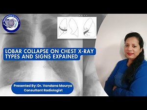 Lobar Collapse on Chest X-ray: Type and Signs Explained