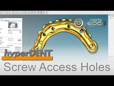 hyperDENT Tutorial: Angulated Screw Channels