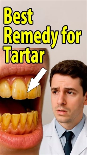 Remove Tartar Fast | Doctor Explains the Real Cause and Simple Fixes