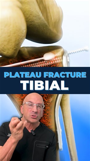 Cory Calendine MD on Instagram: "🎈Balloon Tibioplasty for Tibial Plateau Fracture . This minimally invasive procedure adapts successful vertebral kyphoplasty techniques to repair complex knee injuries with precision. Tibial plateau fractures occur at the top of the shinbone where it meets the knee joint, often from high-energy trauma or falls in elderly patients with osteoporosis. These challenging intra-articular fractures can permanently compromise knee function if not properly treated. Tradi