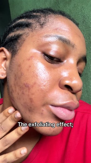 Face Fact Lactic Acid Serum: Clear Acne & Dark Spots in 1 Month