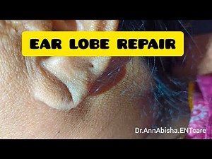 Ear lobe repair procedure - circular technique.