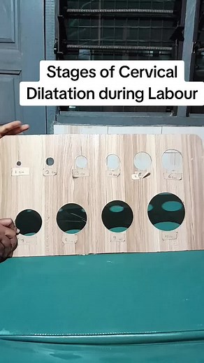 Stages of Cervical Dilatation during Labour: A Complete Guide