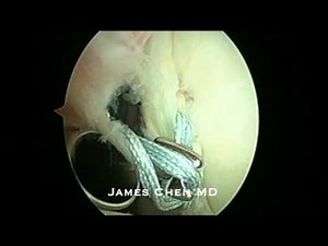 Arthroscopic Posterior Labral Repair