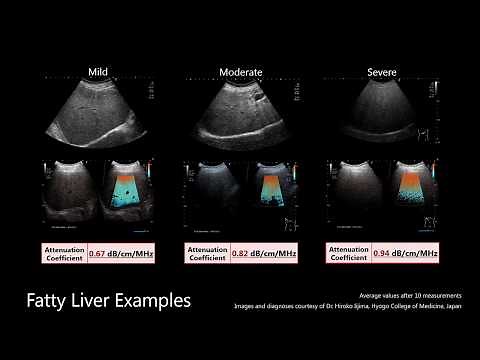 Canon Medical's Attenuation Imaging