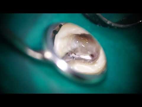 Removal of a non-visible broken file/見えない破折器具の除去