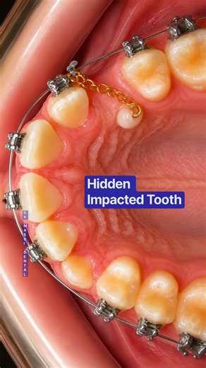 Hidden Impacted Tooth 🦷😬