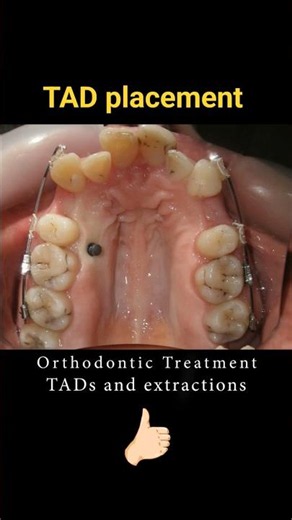 Braces can change smiles! Sometimes extractions are necessary! #shorts #dentist #orthodontist
