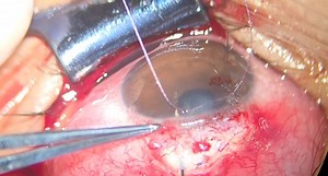 PreserFlo for Bilateral Juvenile Glaucoma With Hyperfiltrating Implant Replacement - Eyetube